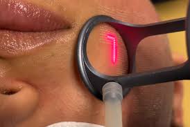 Laser CO2 Fractional RF Technician training at BC Medical Clinic College